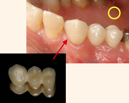 歯肉や隣の歯などと調和している補綴物