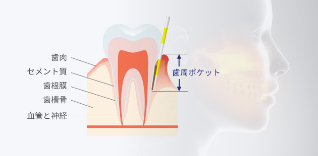 歯周ポケットと口腔内のイメージ