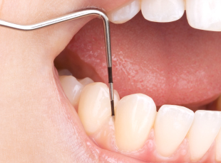 歯周組織精密検査